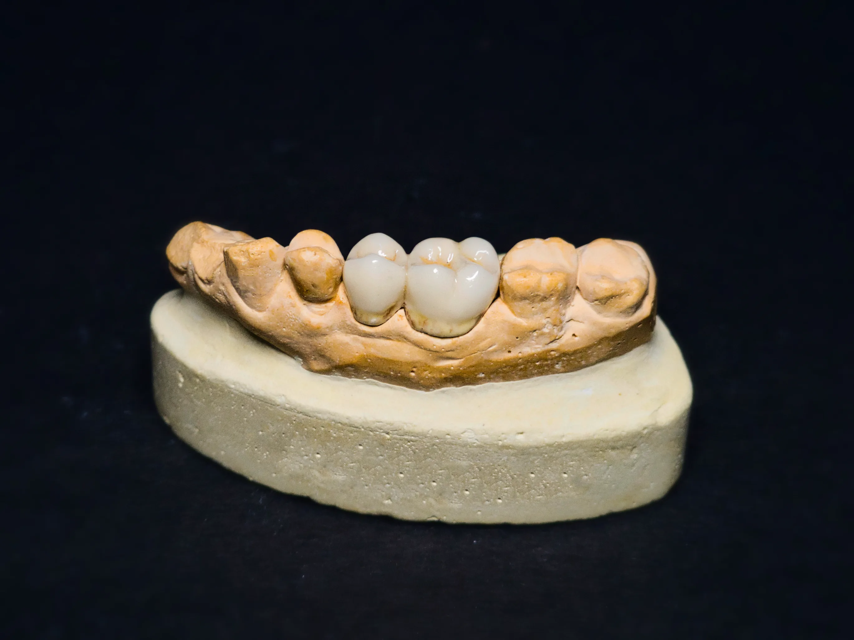 Metal ceramic restoration detail