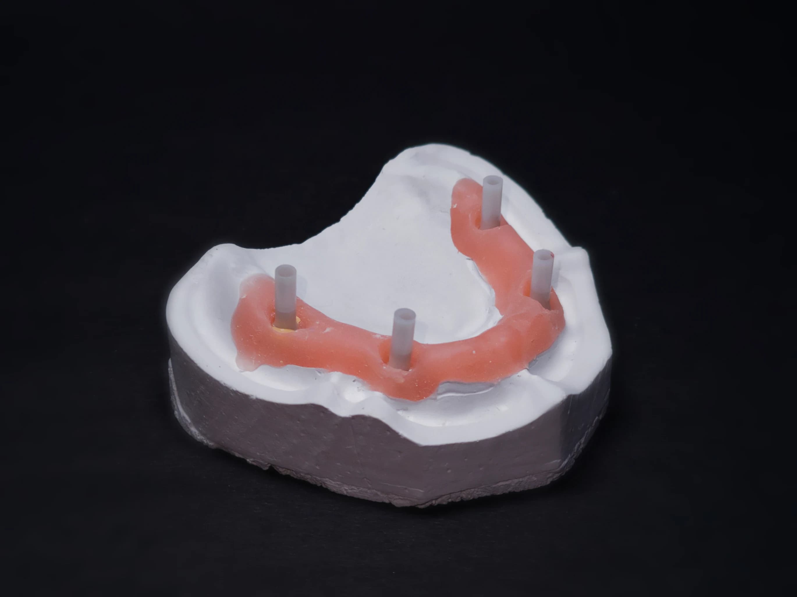 Implant-supported restoration by ARR Dental Lab
