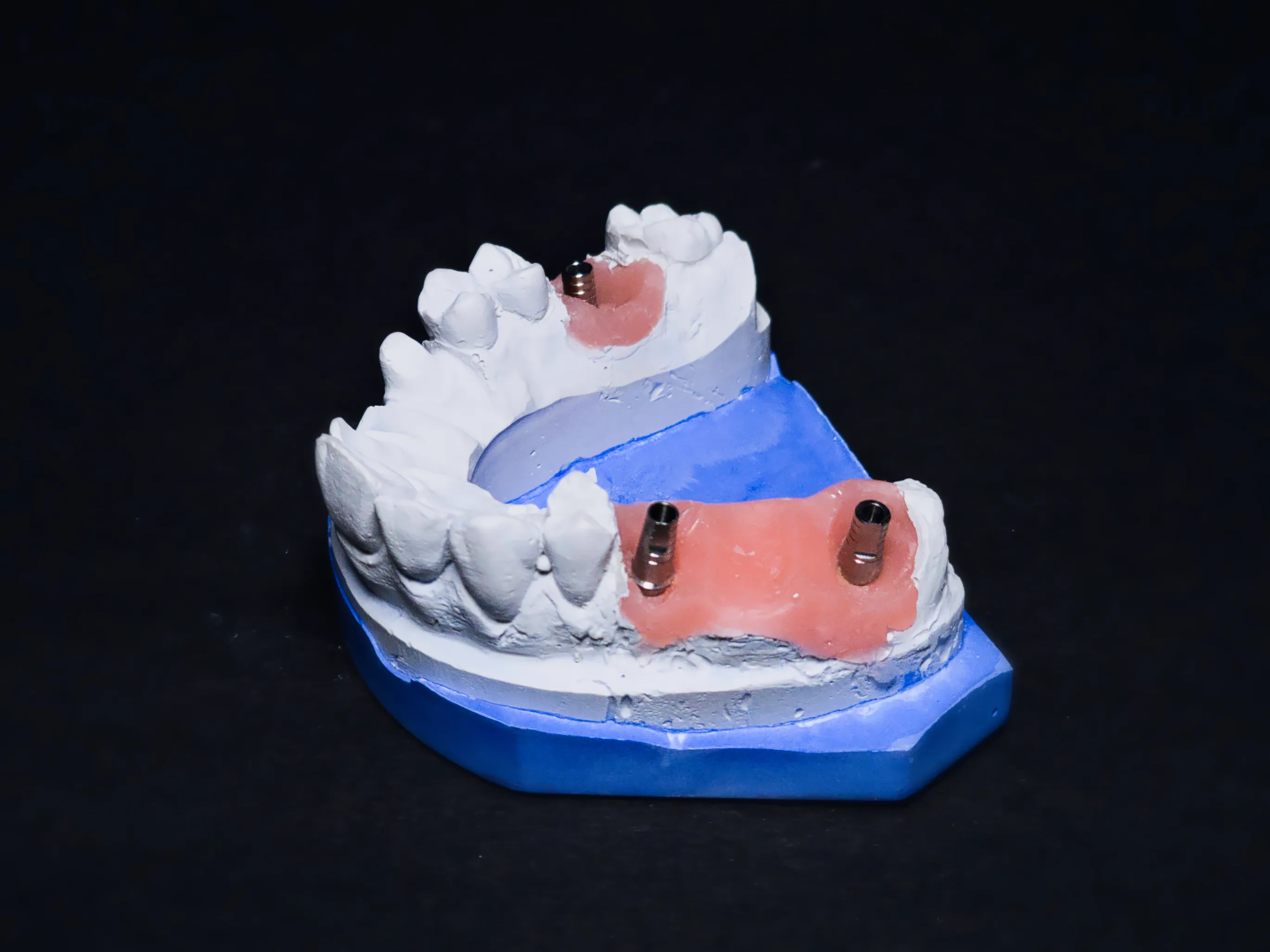 Implant bridge restoration