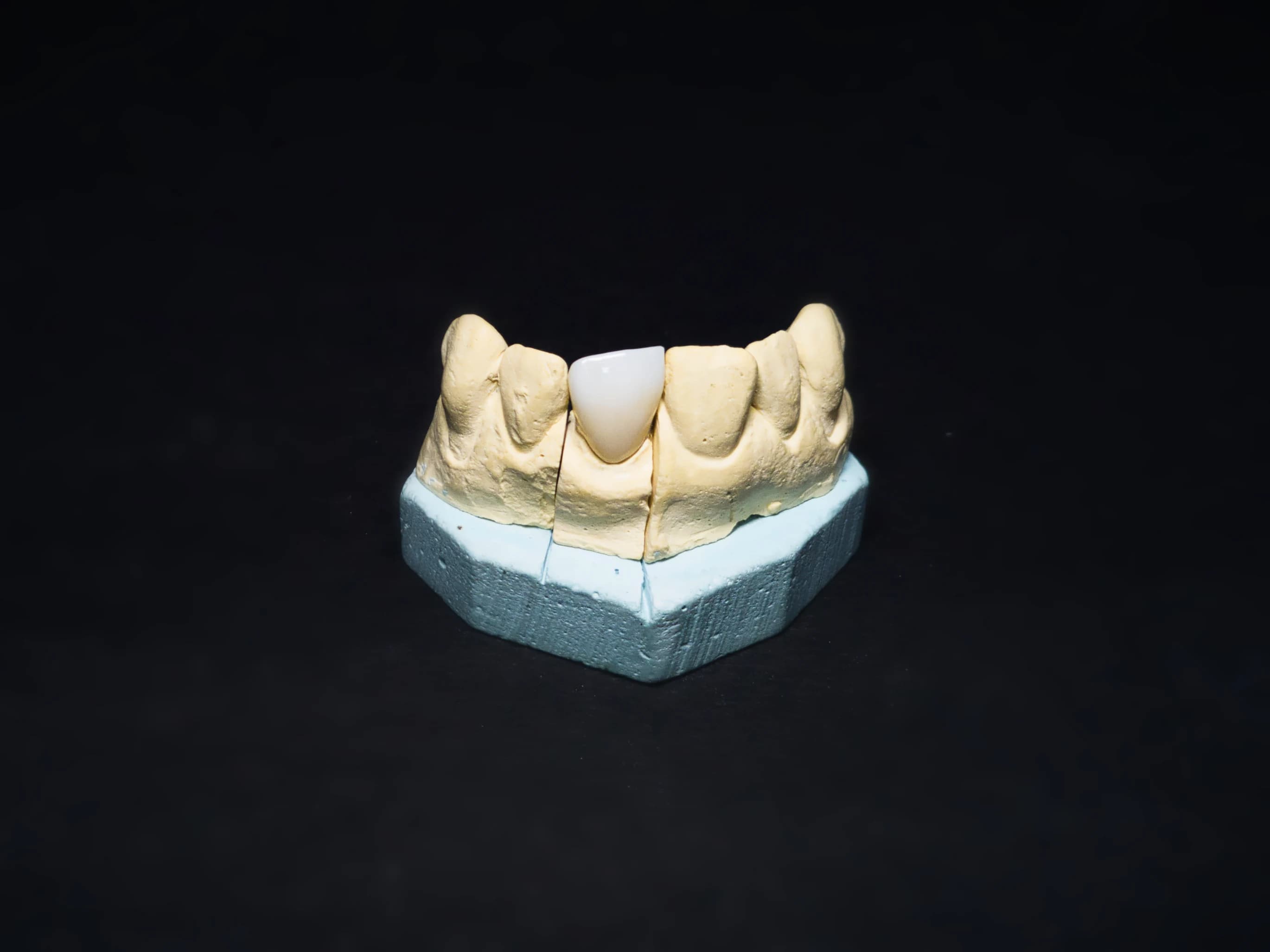 Zirconia crown by ARR Dental Lab