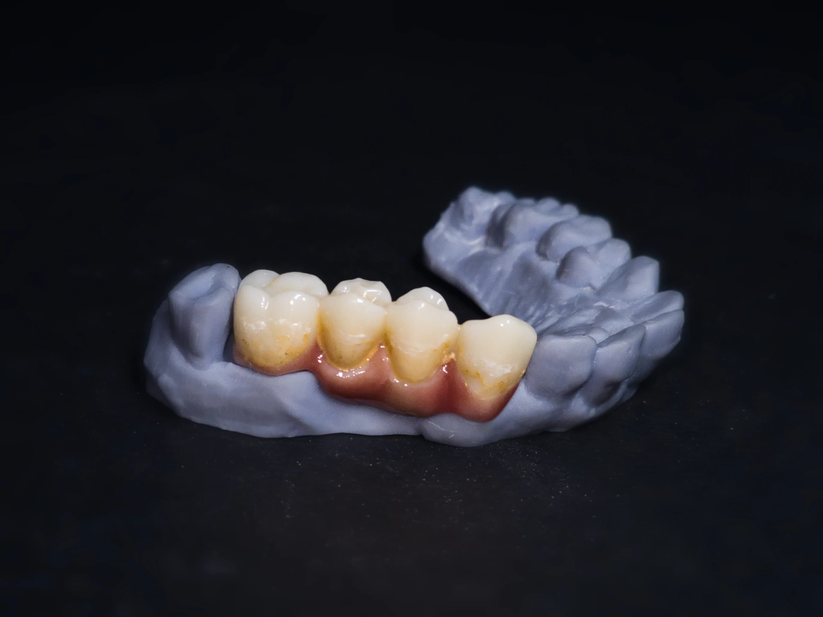 Layered zirconia crown detail
