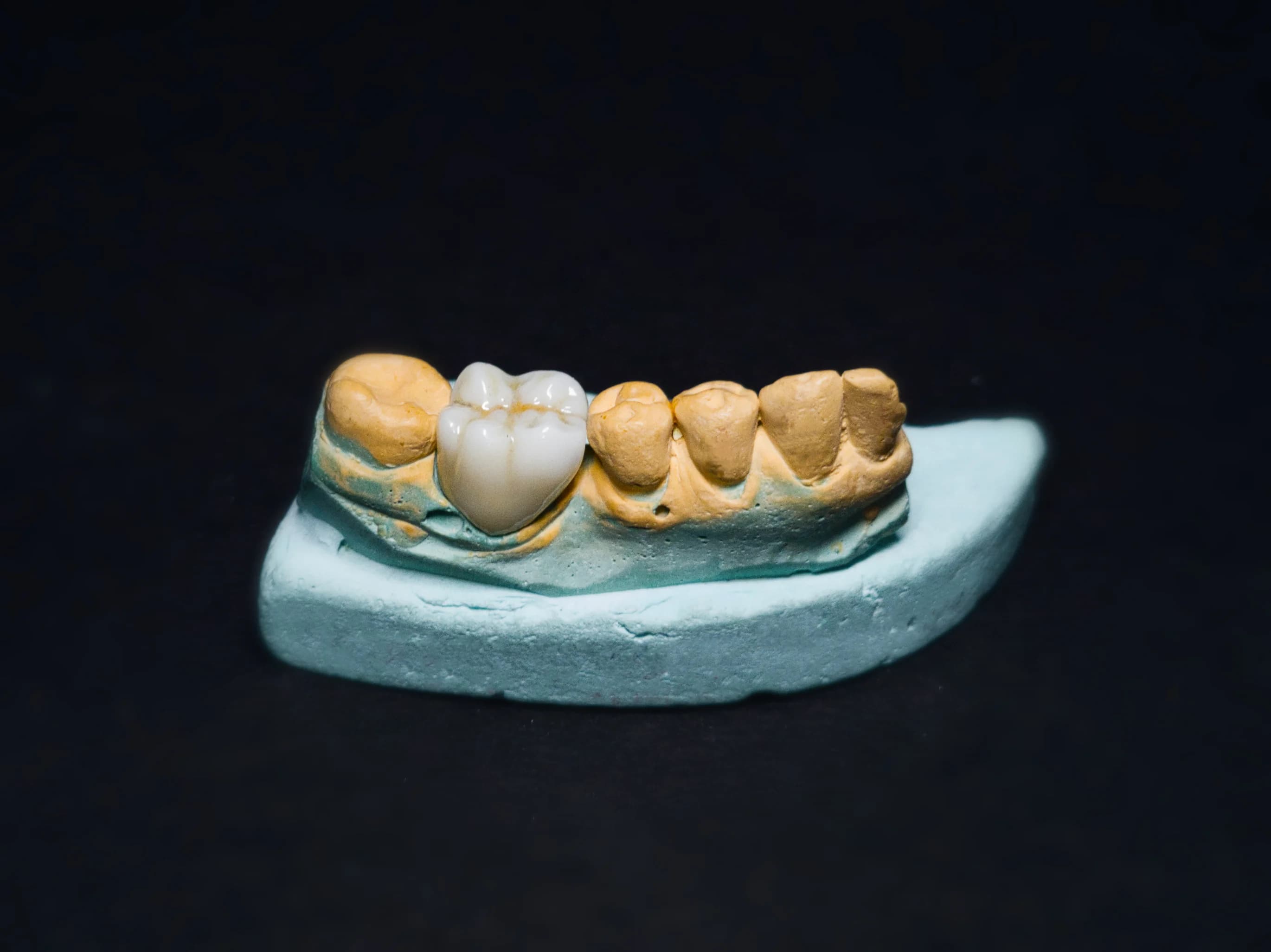 Zirconia bridge restoration