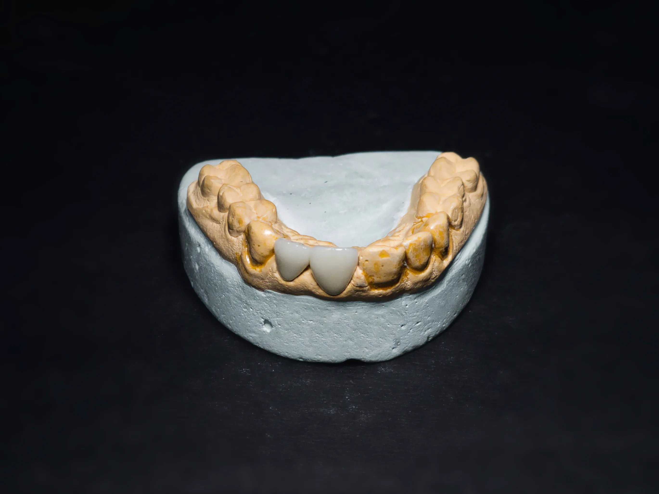 Metal ceramic crown by ARR Dental Lab