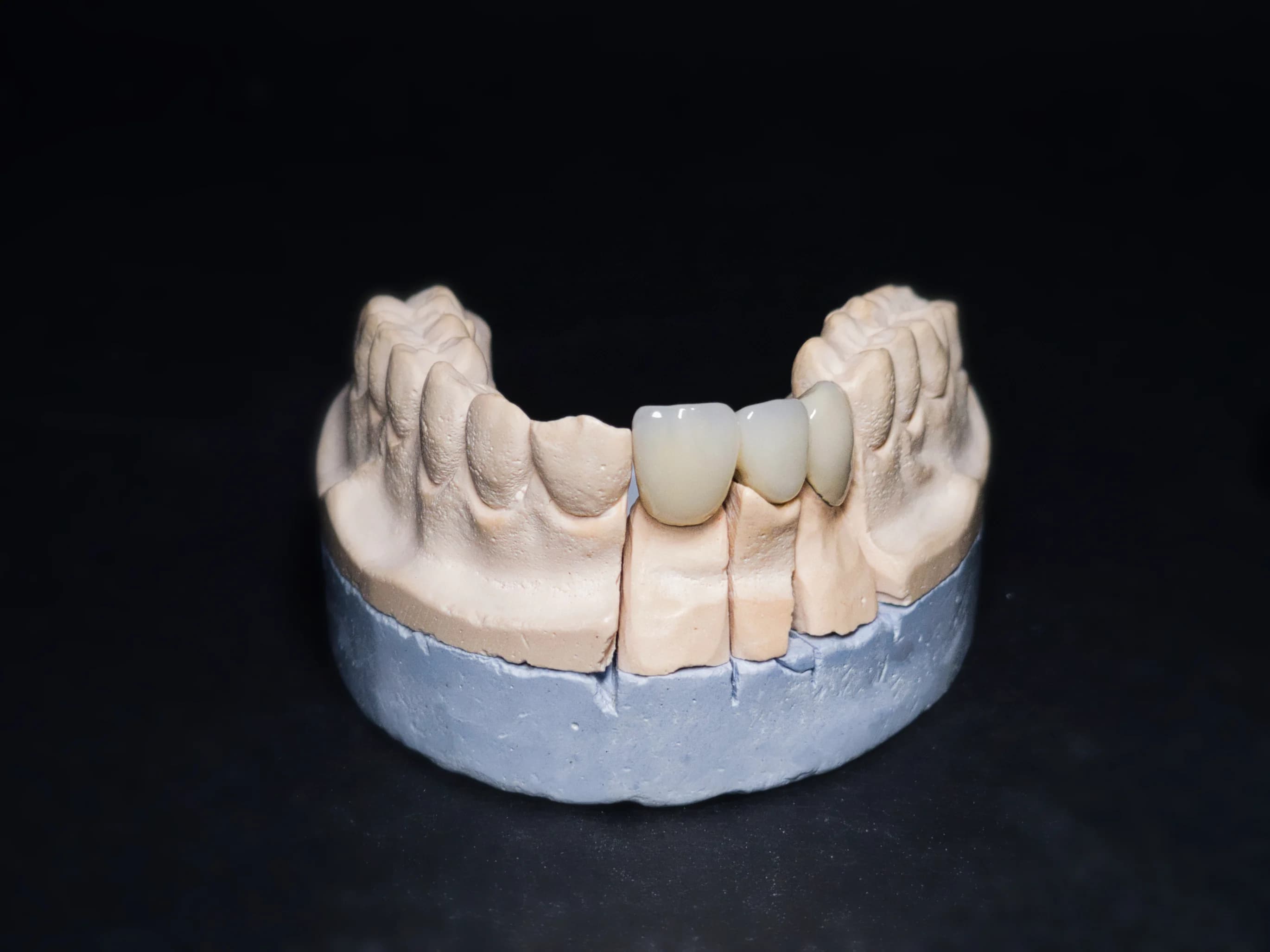 Porcelain fused to metal bridge