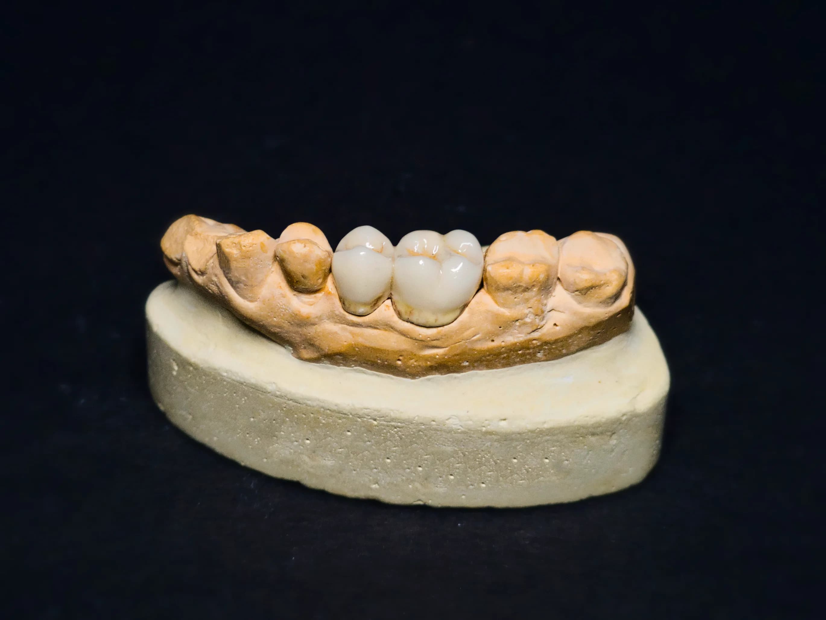 Metal ceramic restoration detail